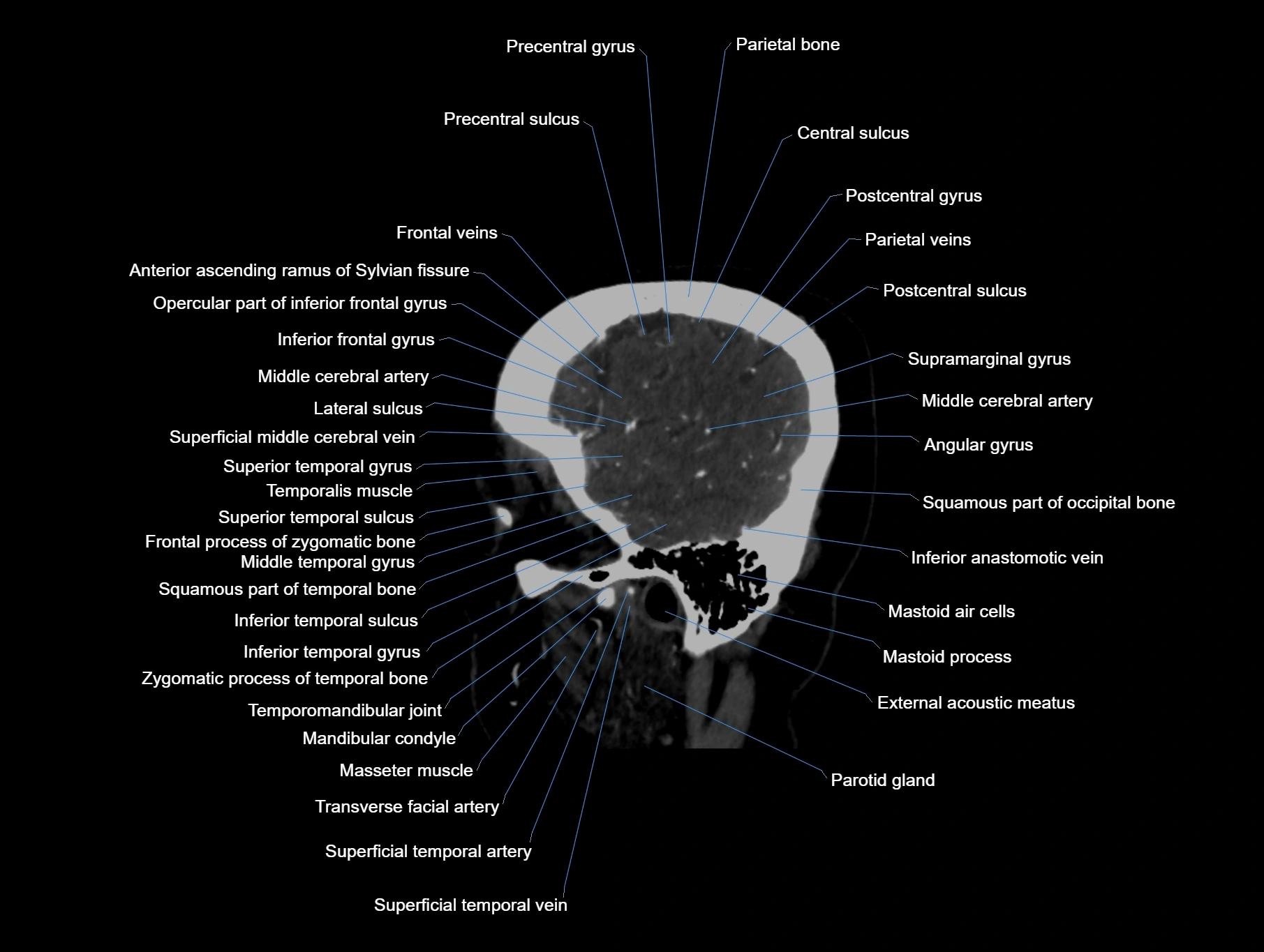 CT scan brain sagittal cross sectional anatomy image-img-00001-00011.webp